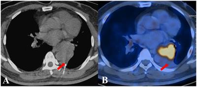 PET/CT-aided biopsy of lung lesions enhances diagnostic efficacy, especially for lesions >3cm